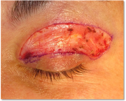 Blefaroplastia 5