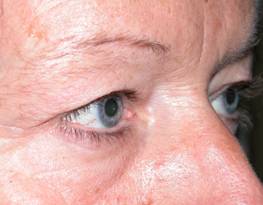 Blefaroplastia 6