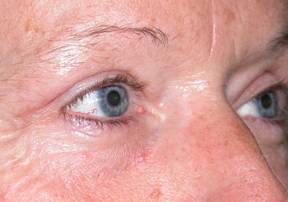 Blefaroplastia 7