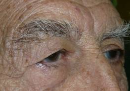 Blefaroplastia 8