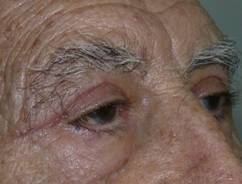 Blefaroplastia 9