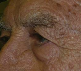 Blefaroplastia 10