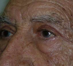 Blefaroplastia 11