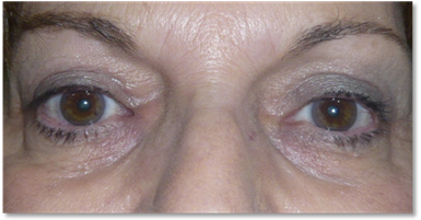 Blefaroplastia 13