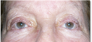 Blefaroplastia 15