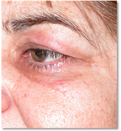Blefaroplastia 16