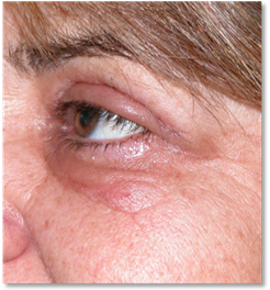 Blefaroplastia 17