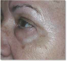 Blefaroplastia 18