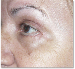 Blefaroplastia 19