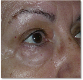 Blefaroplastia 20