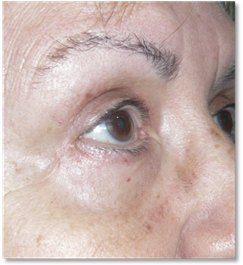 Blefaroplastia 21