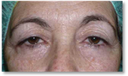 Blefaroplastia 24
