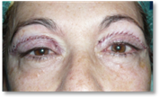 Blefaroplastia 25