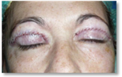 Blefaroplastia 26