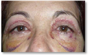 Blefaroplastia 27