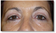 Blefaroplastia 28