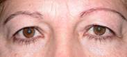 Blefaroplastia 29
