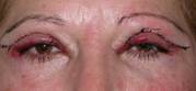 Blefaroplastia 30