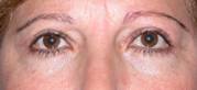 Blefaroplastia 33