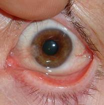 Pterigium pinguécula 4