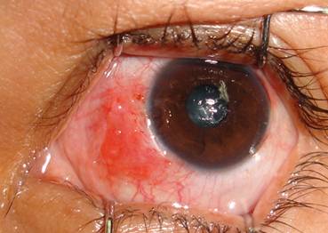 Pterigium pinguécula 10
