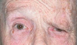 Ptosis de ceja 5