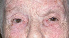 Ptosis de ceja 6