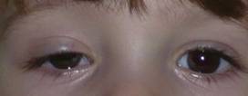 Ptosis palpebral 2