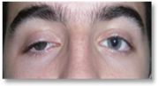 Ptosis palpebral 3