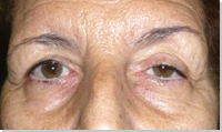 Ptosis palpebral 5