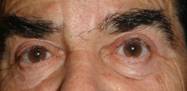 Ptosis palpebral 10