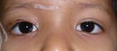 Ptosis palpebral 16