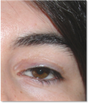 Ptosis palpebral 19