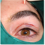 Ptosis palpebral 20