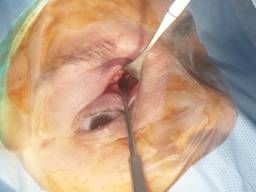 Tumores orbitales 12